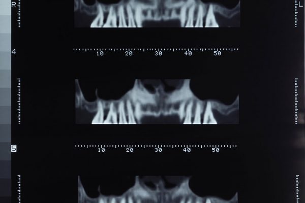 dentascan-2