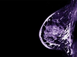 ecografia-mammaria-3